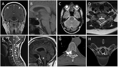 Diagnosis and treatment evaluation in patients with spontaneous intracranial hypotension